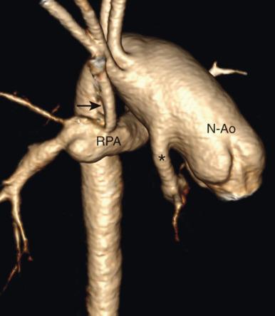 Figure 73.6, A 6-month-old with hypoplastic left heart syndrome after Stage I Norwood procedure.