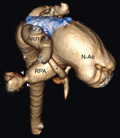 e-Figure 73.7, A 5-month-old with hypoplastic left heart syndrome after the hybrid procedure.