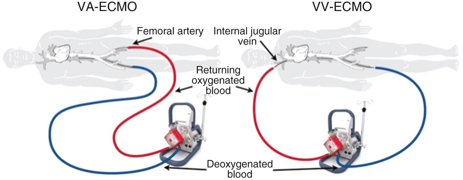 FIGURE 97-3, Extracorporeal membrane oxygenation. ECMO, Extracorporeal membrane oxygenation; VA, venoarterial; VV, venovenous.