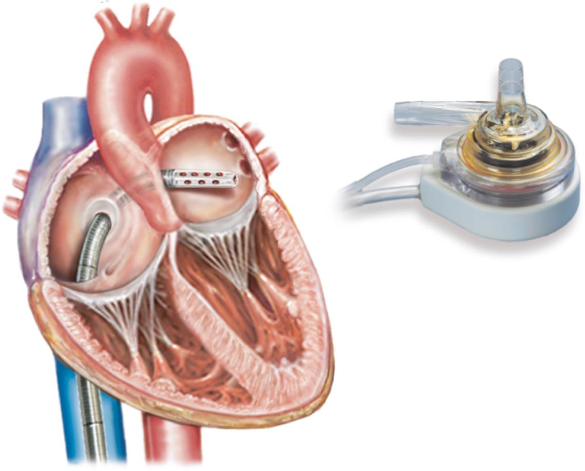 FIGURE 97-4, TandemHeart.