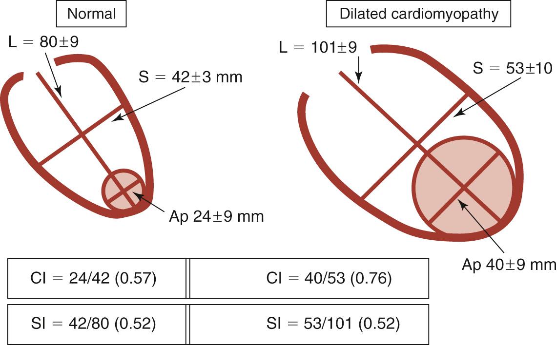 FIGURE 100-1, Geometric measures in normal and dilated cardiomyopathy. Sphericity index (SI) is calculated as the short- to long-axis ratio (S/L), and conicity index (CI) as the apical to short-axis ratio (Ap/S). Apical diameter is determined by using the diameter of the sphere that best fits the apex. Note that the SI has the same value in normal subjects and in patients with dilated cardiomyopathy, because the elongation of the ventricle is proportional to the increase in width, so the ratio remains stable, whereas the CI is markedly abnormal in the patients.