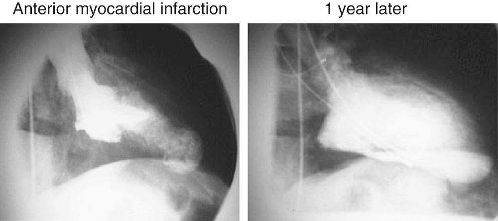 FIGURE 100-3, Left ventricle (LV) angiography, 30-degree right anterior oblique projection. Left, Early after myocardial infarction, systolic frame. Note the small apical aneurysm. The left anterior descending artery was successfully reperfused. Right, The LV angiogram 1 year later showed marked end-systolic volume dilation of the ventricle, and the patient had symptoms of heart failure.