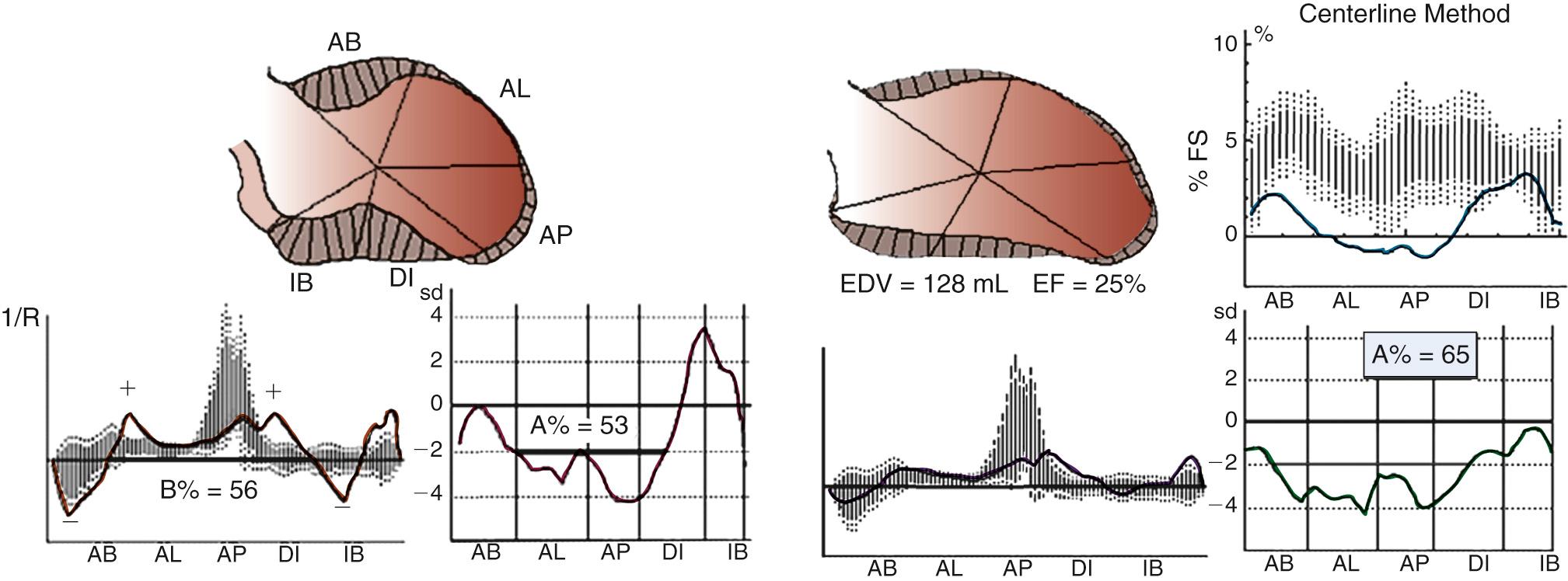 FIGURE 100-4, Left ventricular (LV) curvature and regional wall motion analyses in two patients after an anterior myocardial infarction was successfully reperfused. LV shape on the left represents the true aneurysm, with the classic neck at the border between thickening and nonthickening myocardium. LV shape on the right represents the true dilated ischemic cardiomyopathy, without borders between thickening and nonthickening myocardium. Graphs below each silhouette represent the curvature analysis (left) and the centerline analysis (right). Curvature values, expressed as the reciprocal of the radius (1/R) on the ordinate, are measured from the aortic to the mitral plane around the ventricular perimeter. Shadowing indicates standard deviation of normal motion; the line indicates wall motion in the patient. The curvature of the apex is greater in the normal heart and reduced in the patient. Note the sharp variation of curvature values from negative (−) to positive (+) and from + to − in the patient on the left. Curvature values in the patient on the right are extremely reduced without variations (neither negative nor positive)—that is, the curvature is flattened all along the perimeter. Centerline analysis: regional wall motion of 45 chords around the LV perimeter is quantified. A%, Extent of asynergy; AB, anterobasal region; AL, anterolateral region; AP, apical region; B%, extent of curvature abnormalities; DI, diaphragmatic region; EDV, end-diastolic volume; EF, ejection fraction; FS, fractional shortening; IB, inferobasal.