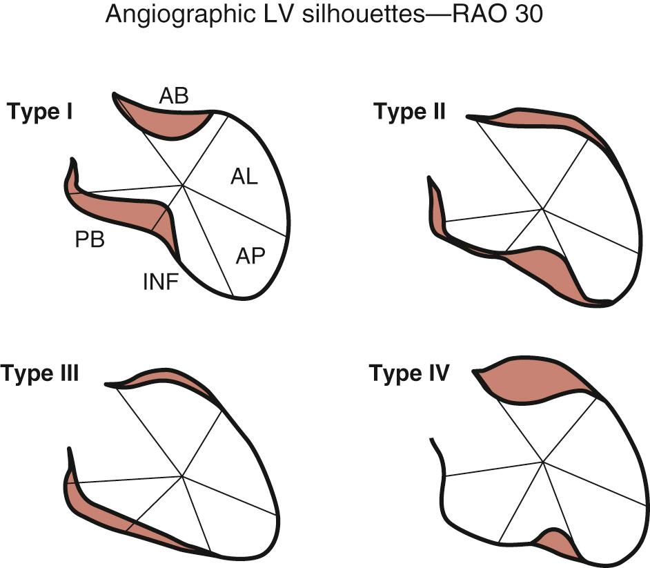 FIGURE 100-5, Silhouettes of left ventricle (LV) shape abnormalities after myocardial infarction. Diagrams represent evaluation by angiography in 30-degree right anterior oblique projection. Type 1: LV shape is geometrically delimited by two systolic “borders” between thickening and nonthickening myocardium; the classic neck of the true aneurysm is evident. Type 2: The shape is characterized by only one border between thickening and nonthickening myocardium, not two borders as in type 1. Type 3: LV systolic shape is without borders (i.e., the curvature is flattened along the overall perimeter of the ventricle). Type 4: Double-site myocardial infarction (anterior and inferior). AB, Anterobasal region; AL, anterolateral region; AP, apical region; INF, inferior; PB, posterobasal region; RAO, right anterior oblique projection.