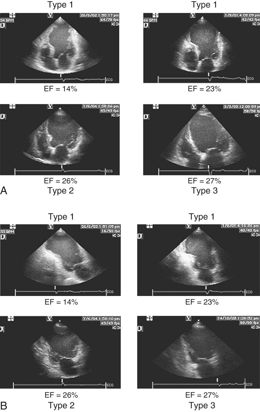 FIGURE 100-6, Echocardiographic four-chamber (A) and two-chamber (B) views are shown in four patients after an anterior myocardial infarction. All patients have marked left ventricular dilation with low ejection fraction (EF), but the shapes are definitely different. Types 1, 2, and 3 are shown.