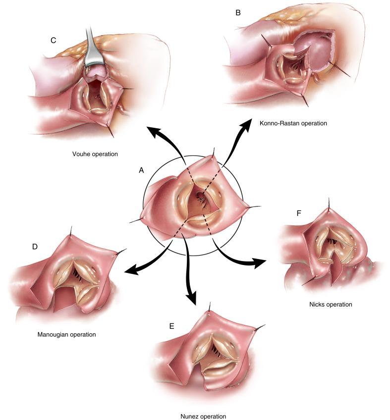 Figure 17-1, A This illustration shows the aortic root and the various points at which the aortic annulus can be divided to open the left ventricular outflow tract. The options include an anterior incision medial to the orifice of the right coronary artery (Konno-Rastan operation), an anterior incision through the medial commissure of the aortic valve (Vouhe operation), and posterior enlargement incisions. An incision into the posterior commissure and the interleaflet triangle below it has been described by Manougian and Nunez; an incision at the low midpoint in the noncoronary sinus is attributed to Nicks. B The Konno-Rastan operation is commonly referred to as an aortoventriculoplasty because the incision extends from the aorta medially across the aortic annulus into the right ventricular outflow tract and the ventricular septum. C The Vouhe operation is also an aortoventriculoplasty. The aortic incision is through the commissure between the left and right coronary cusps of the aortic valve. Thus, the incision into the right ventricle is made in the outlet portion and into the infundibular septum. This offers the option of preserving the aortic valve if it is normal or repairable. D In the Manougian operation, an incision is extended from the aorta through the posterior commissure between the left and noncoronary cusps of the aortic valve, into the interleaflet triangle, and across the mitral annulus about 1 cm into the middle of the anterior leaflet of the mitral valve. The left atrium is also opened. E In the Nunez operation, described 4 years after the Manougian operation, an incision is also made through the posterior commissure into the interleaflet triangle, but it stops short of entering the mitral valve and the left atrium. F The Nicks operation extends an aortic incision across the aortic valve annulus at the midpoint of the noncoronary sinus into the anterior aspect of the anterior leaflet of the mitral valve. The left atrium is also opened.