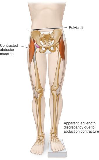 Fig. 109.2, An example of apparent leg length inequality due to abduction contracture.