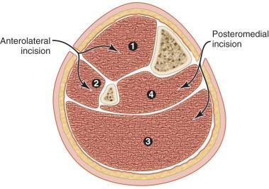 Fig. 113.1, A cross-sectional diagram of the leg demonstrating the compartments and the location for medial and lateral fascial incisions. 1 , Anterior compartment; 2 , lateral compartment; 3, superficial posterior compartment; 4 , deep posterior compartment