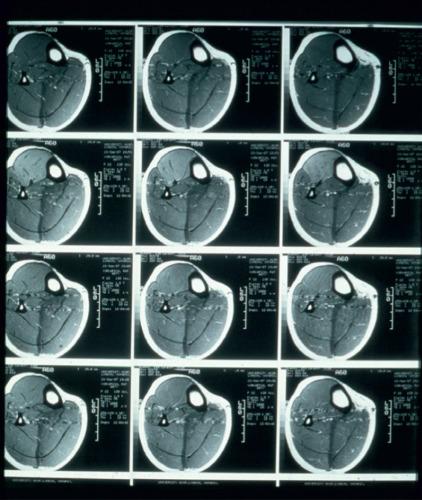 Fig. 113.2, Magnetic resonance imaging findings in a person with chronic exertional compartment syndrome involving the anterior compartment musculature before exercise (top row), 5 minutes after exercise (second row), 10 minutes after exercise (third row), and 15 minutes after exercise (fourth row).