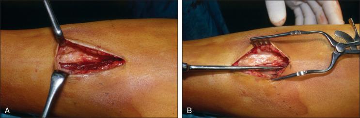 Fig. 113.3, (A and B) Fascial incisions for posterior compartment releases. The muscle fascia is taken directly off the posteromedial border of the tibia.