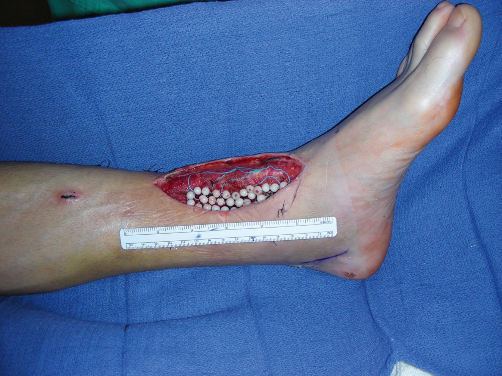 Fig. 46.1, An intraoperative view showing a 12 × 6-cm complex soft tissue wound in the distal tibial of the left leg extending to the ankle with the exposed fracture site, reconstruction plate, and antibiotic beads.
