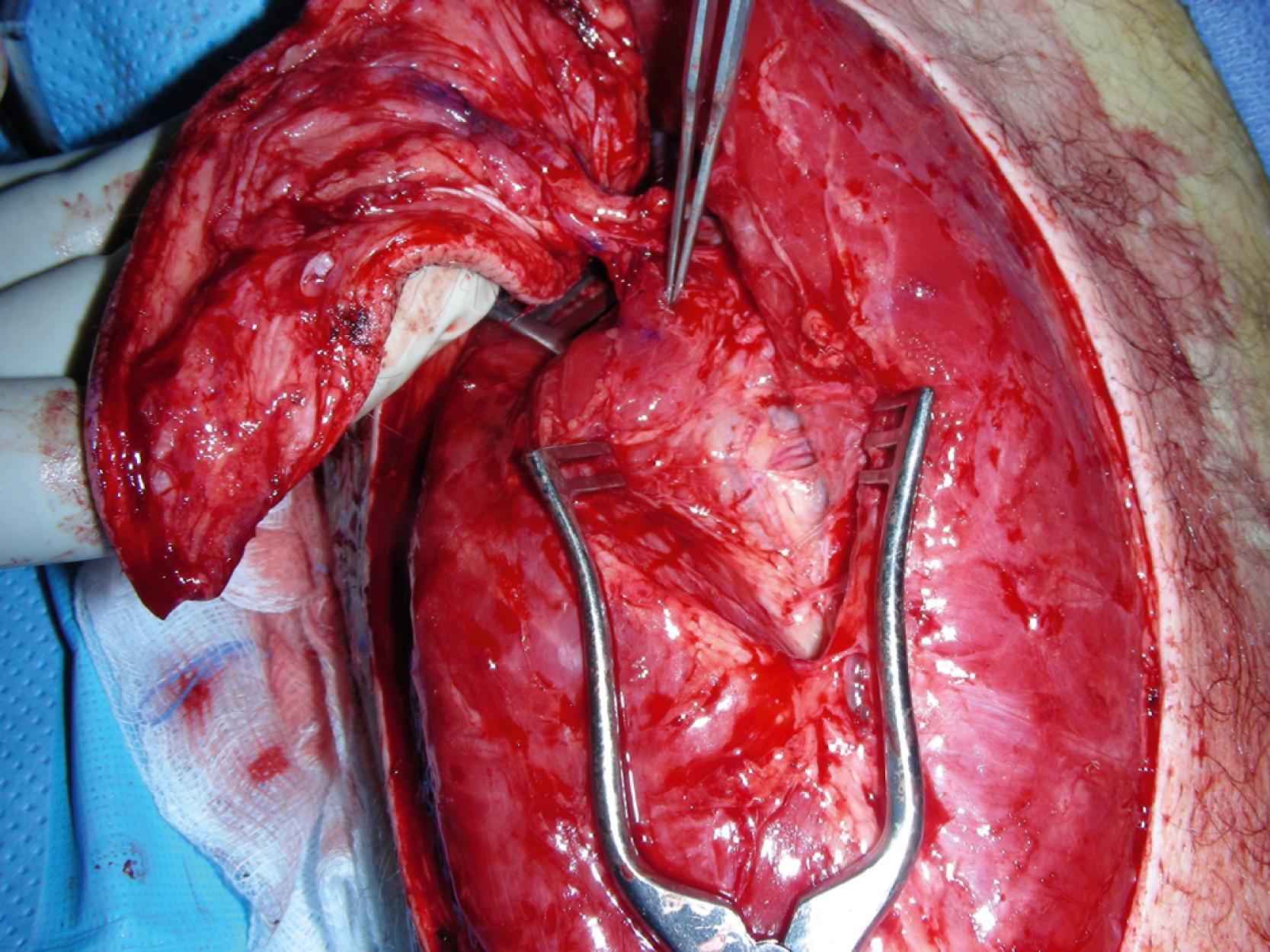 Fig. 46.3, An intraoperative view showing the large perforator of the flap that was dissected free. It traveled through the vastus lateralis muscle and joined to the descending branch of the lateral circumflex femoral artery.