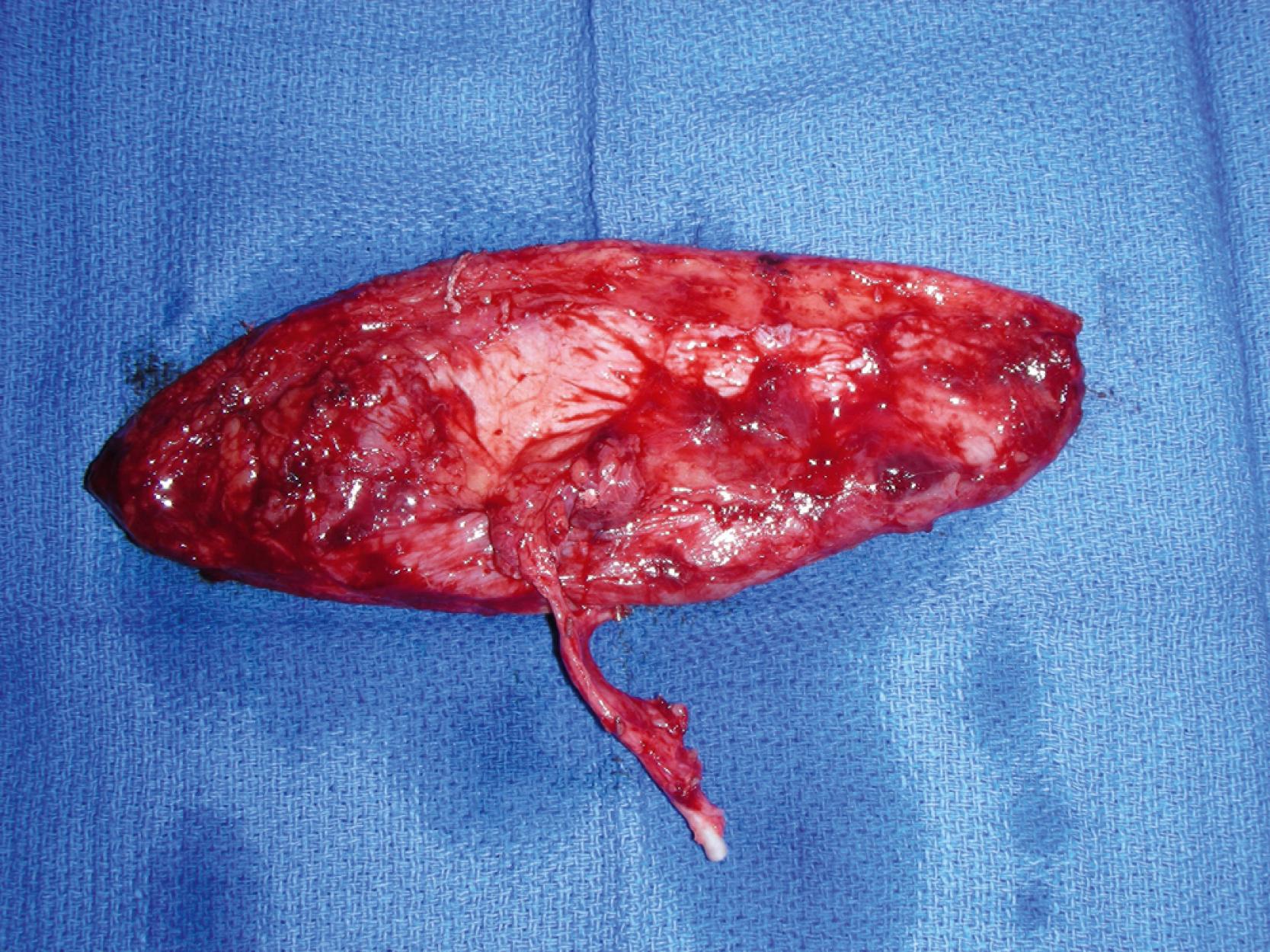 Fig. 46.4, An intraoperative view showing complete dissection of the anterolateral thigh flap. The flap was based on a single large perforator.