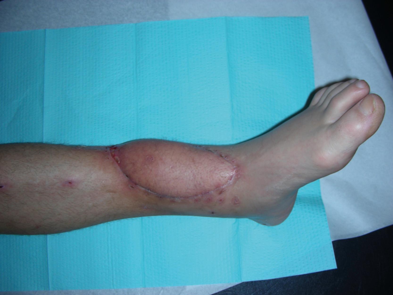 Fig. 46.6, Results at 3-week follow-up showing well-healed and stable left distal third of the leg wound after the flap reconstruction with some flap bulking and minimal scarring.
