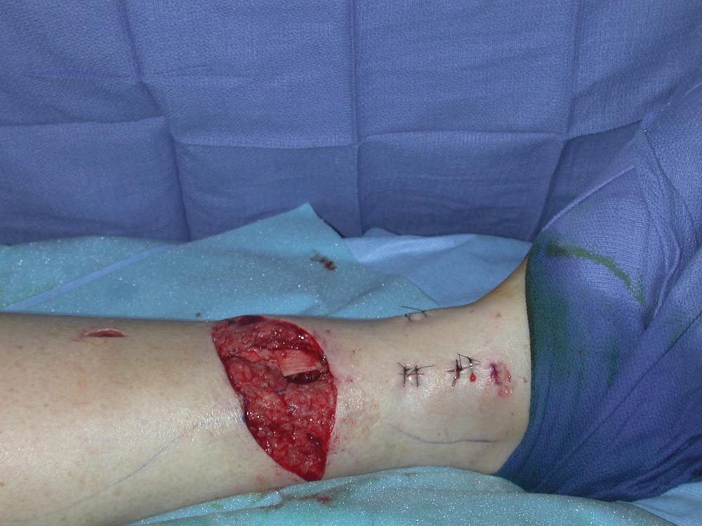 Fig. 45.1, A preoperative view showing a 5 × 4 cm open tibial wound in the distal third of the left leg with an exposed tibial fracture site.