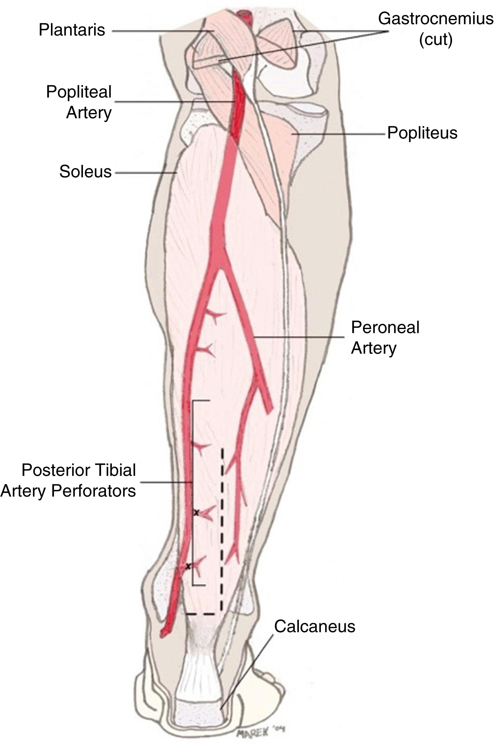 Fig. 45.3, A schematic diagram showing the blood supply to the medial and lateral halves of the soleus muscle as well as splitting of the muscle (dotted line) for the medial hemisoleus muscle flap dissection.