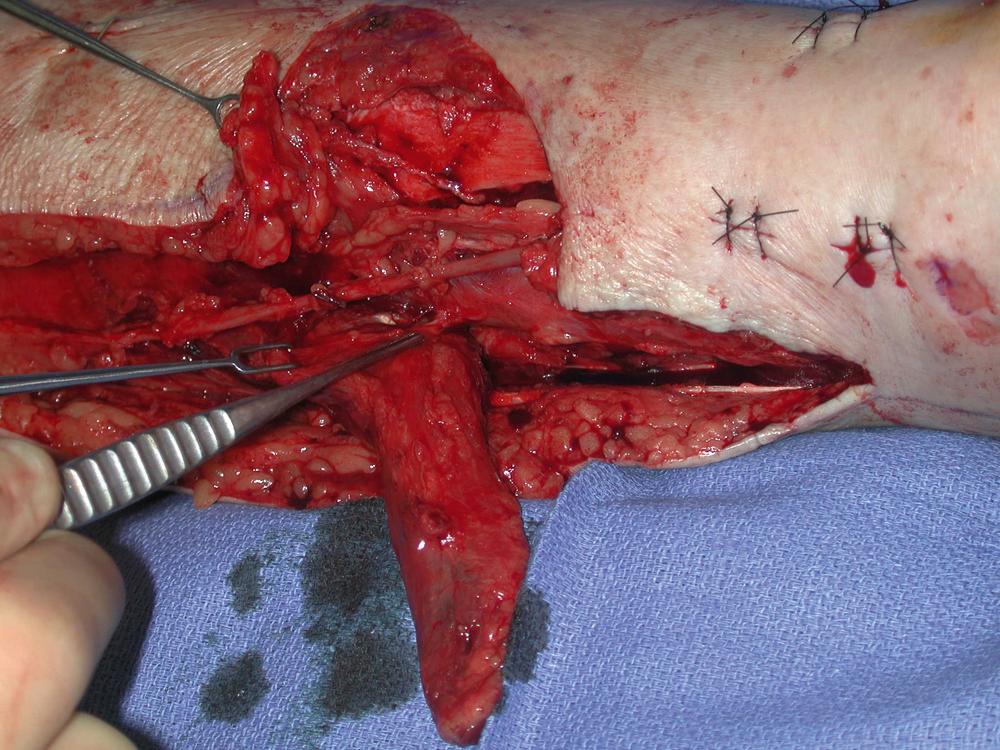 Fig. 45.4, An intraoperative view showing a perforator (indicated by forceps ), adjacent to the distal tibial wound from the posterior tibial vessels to the medial hemisoleus, that should be preserved. This perforator may be critical to ensure an adequate blood supply to the distal portion of the flap.