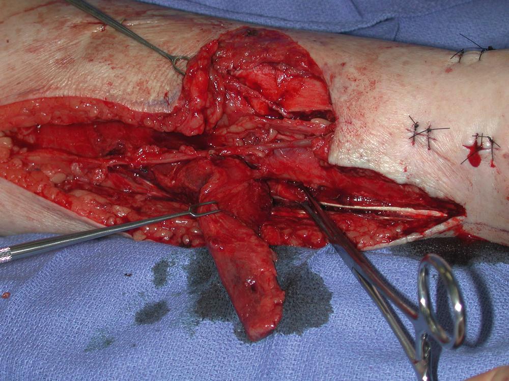 Fig. 45.5, An intraoperative view showing the well-preserved perforator from the posterior tibial vessels to the medial hemisoleus muscle flap. This perforator would not restrict the arc rotation of the flap.