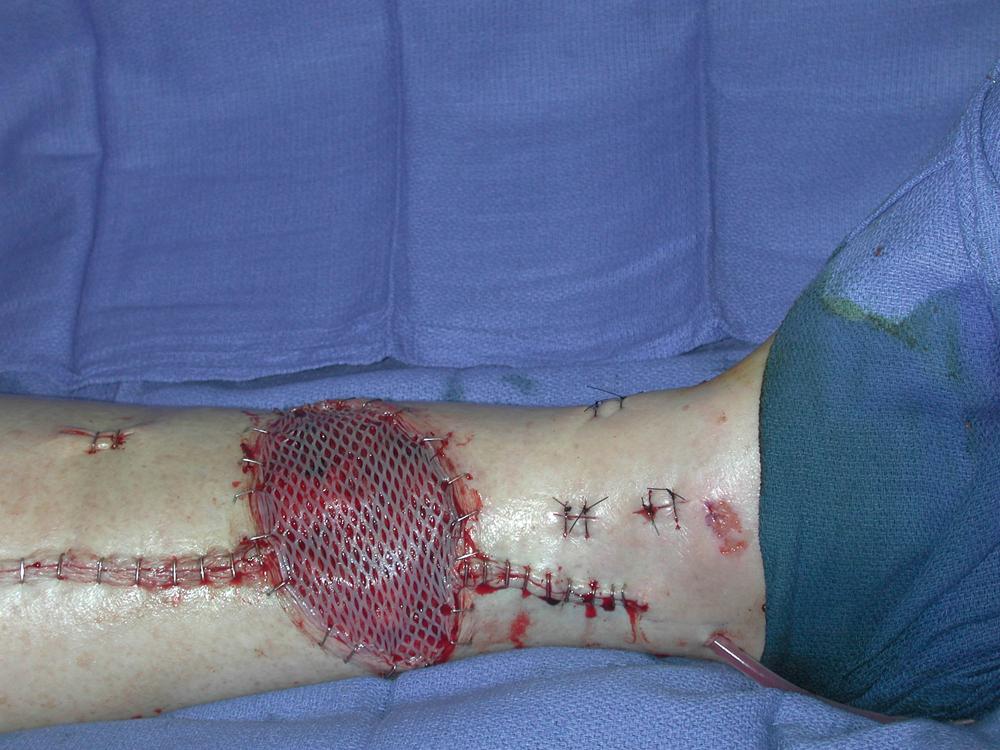 Fig. 45.6, An intraoperative view showing completion of flap inset and placement of a skin graft over the muscle flap as well as incision closure.