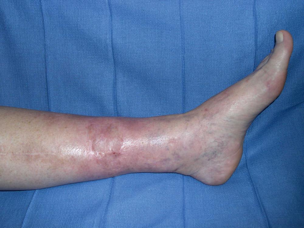 Fig. 45.7, Results at follow-up 2 years and 4 months after flap reconstruction showing well-healed distal-third tibial wound with excellent contour and minimal scarring.