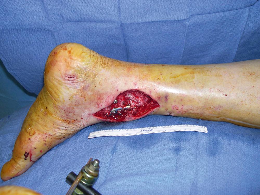 Fig. 45.8, A preoperative view showing a 9 × 5 cm open tibial wound in the distal third of the left leg extending to the ankle with exposed tibial fracture site and hardware.