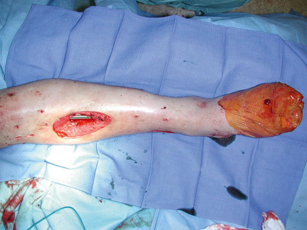 Fig. 44.3, An intraoperative view showing an open middle tibial fracture wound after an orthopedic debridement and internal fixation with a rod.