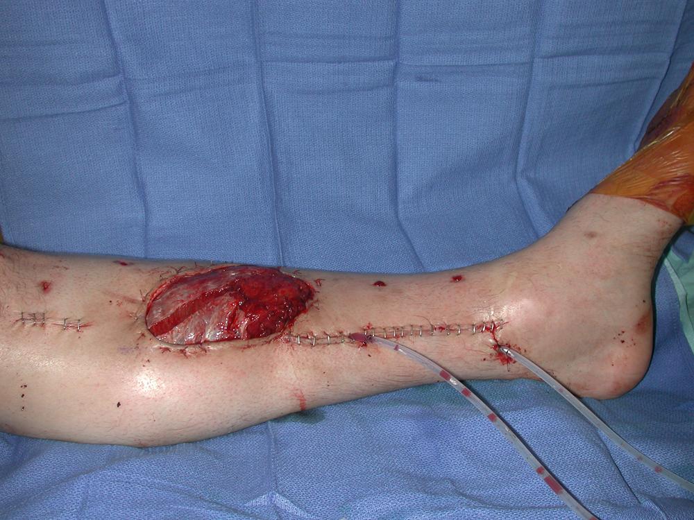 Fig. 44.6, An intraoperative view showing completion of the muscle flap inset before placement of a skin graft.