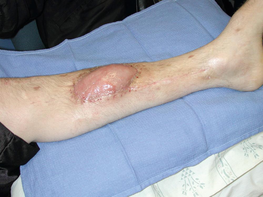 Fig. 44.8, Result at 5-week follow-up showing well-healed left middle-third tibial wound after the flap reconstruction.