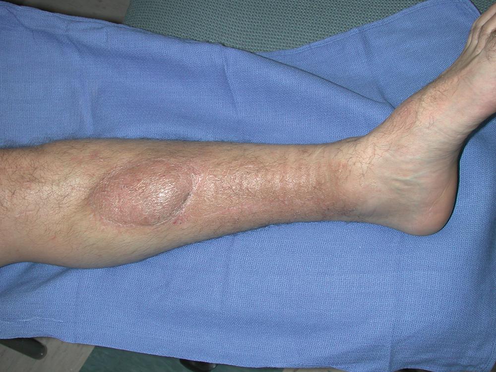 Fig. 44.9, Result at 6.5-month follow-up showing well-healed left middle third tibia wound after flap reconstruction with good contour and minimal scarring.