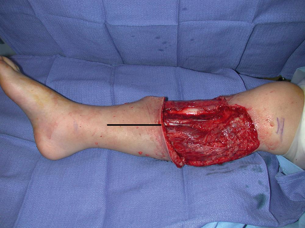 Fig. 43.3, An intraoperative view showing the planned incision for dissection of the medial gastrocnemius muscle flap.