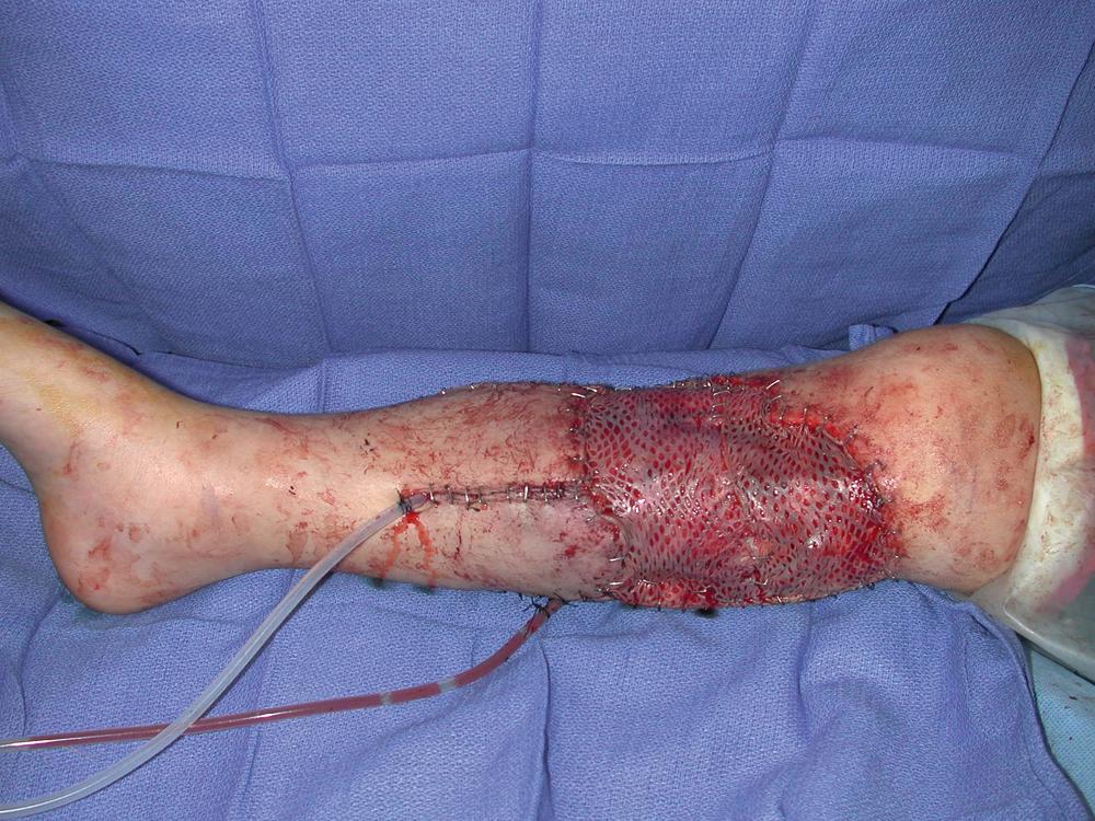 Fig. 43.4, An intraoperative view showing completion of the medial gastrocnemius muscle flap reconstruction. In this case, local skin rearrangement was performed and split-thickness skin grafts were added for the entire wound closure.
