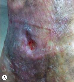 FIGURE 46.1, The most common leg ulcers. (A) A venous leg ulcer on the medial malleolus of a patient, with characteristic scattered varicosities and hyperpigmentation of the periwound skin. (See Video 46.1 .) (B) Classic “punched-out” appearance of an arterial ulcer with copious yellow fibrinous exudate and poor granulation tissue. (C) Plantar diabetic foot ulcer. (D) Pressure ulcer overlying the bony prominence of the heel.