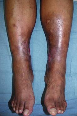 FIGURE 46.2, Diffuse hyperpigmentation associated with the indurated skin characteristic of lipodermatosclerosis.