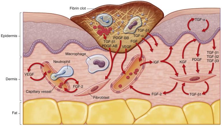 FIGURE 46.4, A diagrammatic representation of the key events during the inflammatory phase of normal wound healing. FGF, FGF-2, fibroblast growth factors; IGF, insulin-like growth factor; KGF, keratinocyte growth factor; PDGF, PDGF-AB and -BB, platelet-derived growth factors; TGF-α, -β1, -β2 and -β3, transforming growth factors; VEGF, vascular endothelial growth factor.