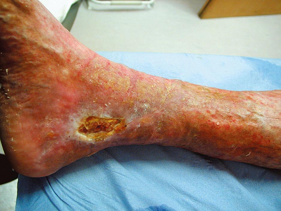 Figure 42, Venous ulcer .