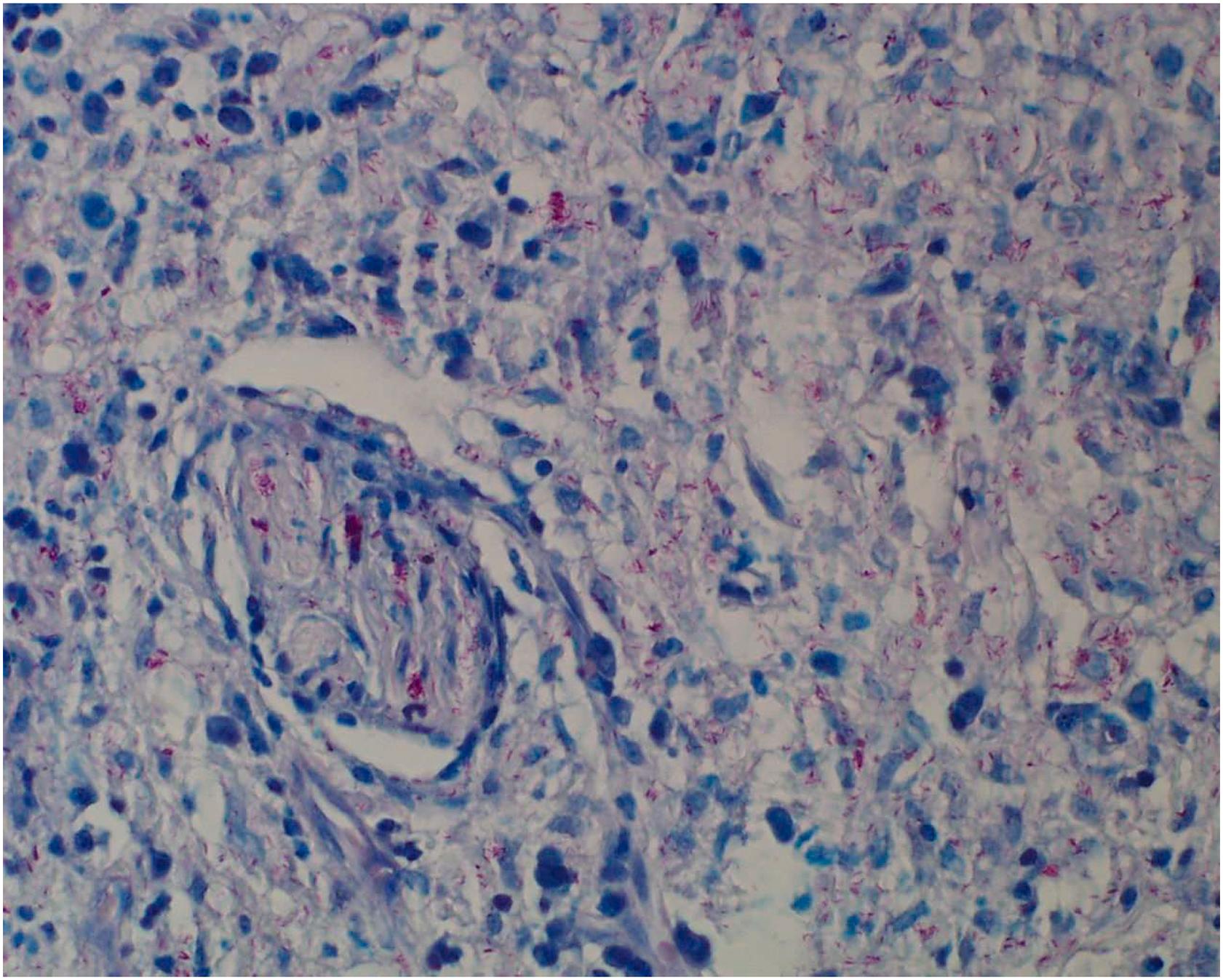 Figure 41-1, Fite-Faraco stain reveals acid-fast bacilli in the nerve, seen in skin biopsy at 100× magnification.