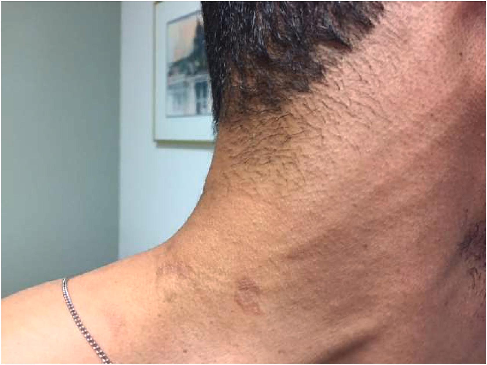 Figure 41-2, Patient with tuberculoid leprosy and an enlarged posterior auricular nerve.