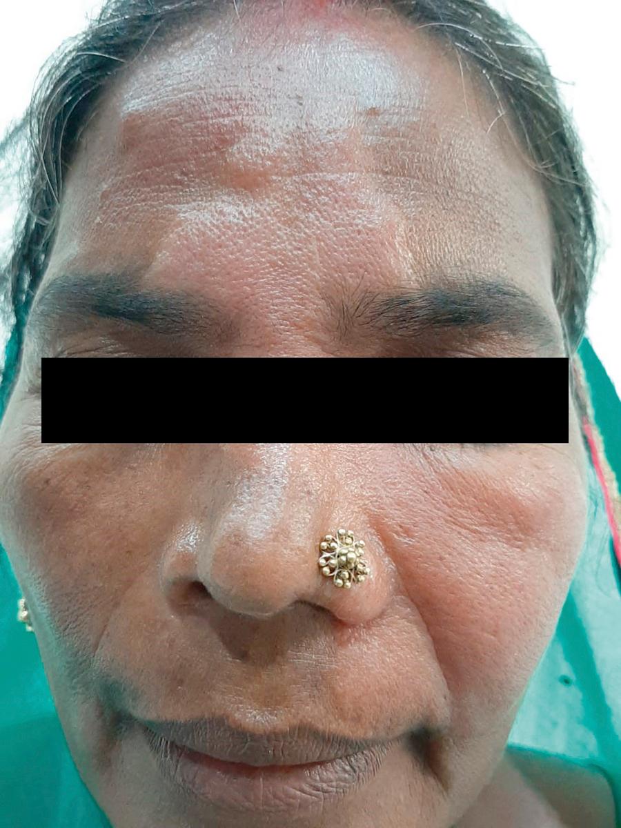 E-FIGURE 301-2, Type 1 reaction in borderline tuberculoid leprosy. The existing lesion on forehead has become erythematous, edematous and shiny.