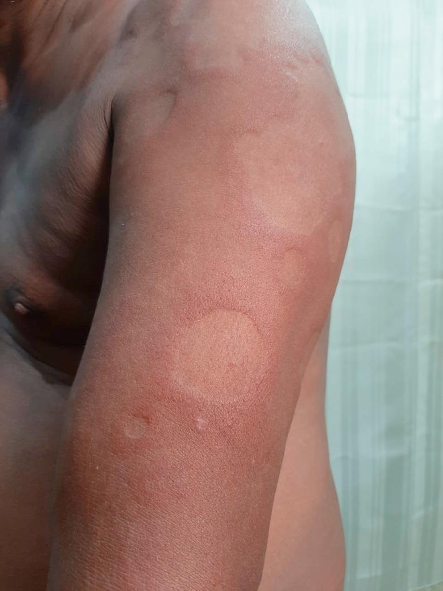 FIGURE 301-2, Annular lesions of borderline borderline leprosy.