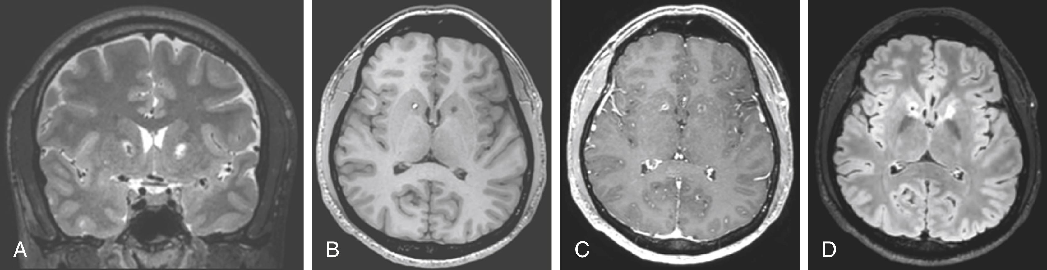FIGURE 109.2, Gamma Knife capsulotomy neuroimaging. Lesions from bilateral Gamma Knife capsulotomy are show in the (A) coronal plane with T2-weighted imaging, (B) axial plane with T1-weighted imaging, (C) axial plane with T1-weighted imaging with contrast, and (D) axial plane with fluid-attenuated inversion recovery imaging.