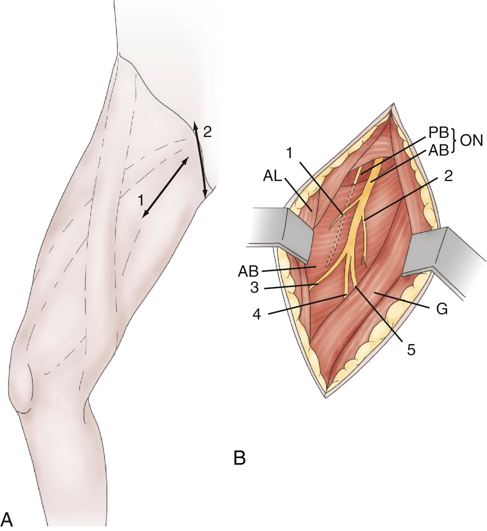 Figure 126.4, Obturator neurotomy (right side).