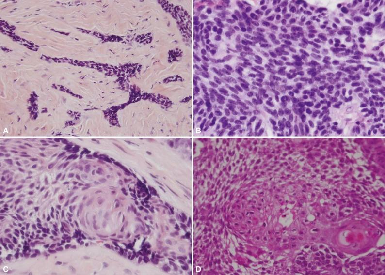 Figure 14-1, Adamantinoma. A, Predominantly dense fibrous background with embedded basaloid cells. B, Highly cellular spindle cells. C and D, Squamoid epithelial nests associated with keratin formation in a background of basaloid cells.