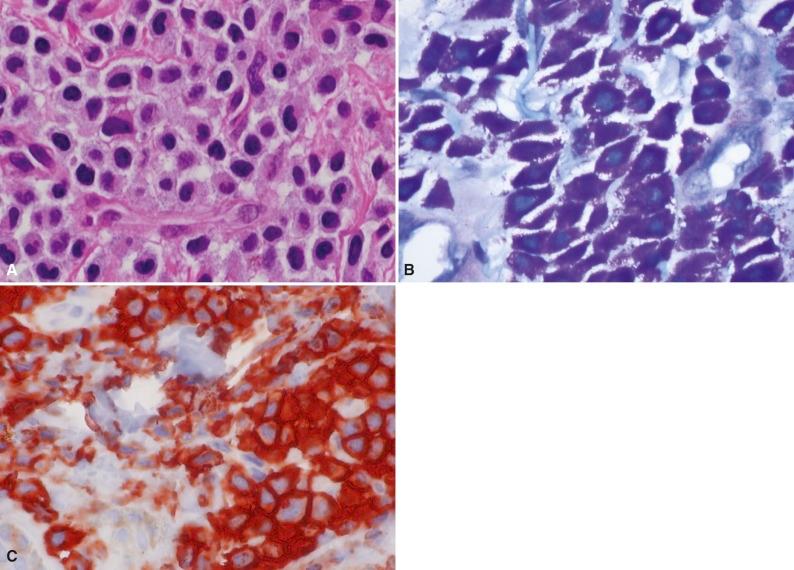 Figure 14-3, Mast cell disease. A, Typical-appearing mast cells with total replacement of bone marrow elements. B, Characteristic cytoplasmic metachromasia associated with Giemsa staining of mast cells. C, Mast cells immunoreact intensely in cytoplasmic pattern with CD117 (C-KIT) antibody.