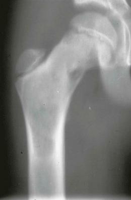 Figure 12-1, Large lesion of fibrous dysplasia in the proximal femur involving both the diaphysis and metaphysis. The lesion is relatively long, with lobular remodeling of the endosteal surface and a “ground glass” mineralization.