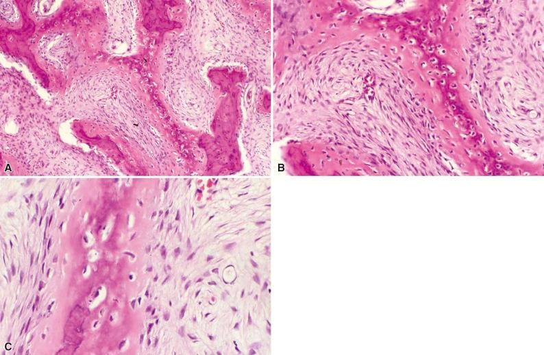 Figure 12-2, A, Interconnecting irregularly shaped or curvilinear trabeculae of woven bone with fibrous tissue in the intertrabecular spaces are characteristic of fibrous dysplasia. B, Higher power view showing bland fibroblasts merging with irregularly shaped woven bone. The fibrous tissue is uniform and contains slightly dilated capillaries. C, Bone formation in fibrous dysplasia occurs by metaplasia directly from the fibroblastic tissue without histologic evidence of osteoblastic differentiation. The collagen fibers of the fibrous stroma are contiguous with the collagen of the lesional bone.