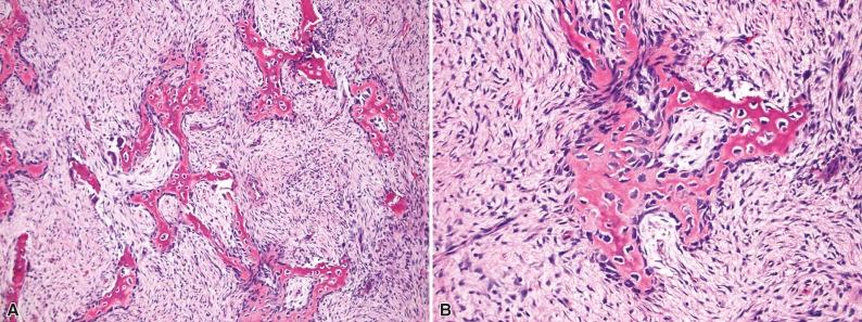 Figure 12-3, A, Interconnecting trabeculae of predominantly woven bone associated with variably cellular fibroblastic tissue. B, On closer inspection, the vast majority of trabecular surfaces are lined by plump active osteoblasts. The fibroblasts are uniform in size and shape with an active appearance characterized by somewhat vesicular nuclear chromatin and small distinct nuclei. Cytologic atypia is lacking in ossifying fibroma.