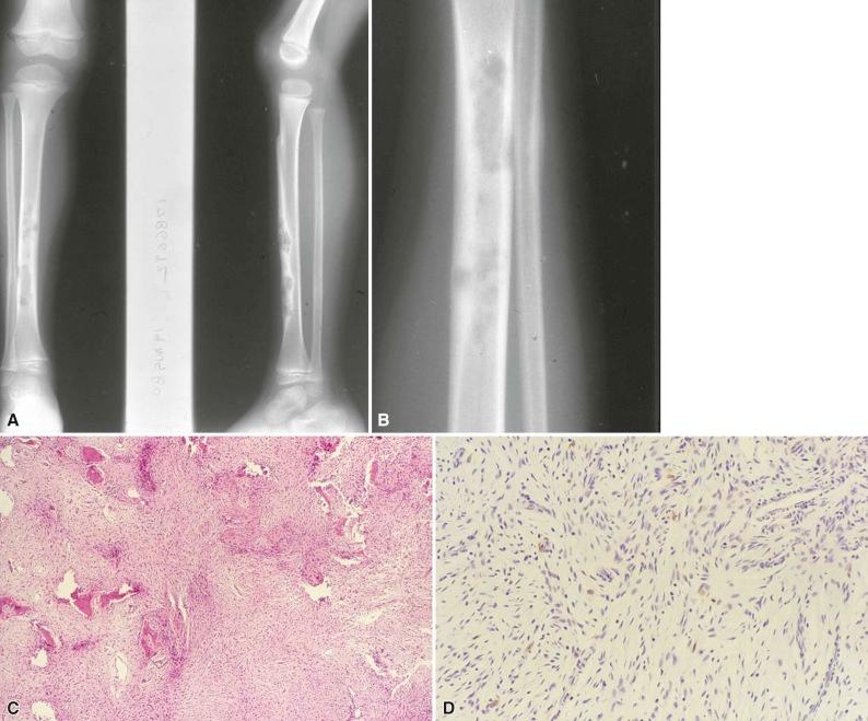 Figure 12-4, A and B, Multilobulated lytic lesion in the anterior cortex of the tibia with some expansile remodeling of an intact cortex is characteristic of osteofibrous dysplasia. C, Active bone formation in osteofibrous dysplasia characterized by small interconnecting trabeculae of woven bone lined by numerous osteoblasts. D, Characteristically, scattered individual spindle cells are positive for cytokeratins by immunohistochemistry (brown chromogen). The lack of epithelial differentiation by light microscopy helps distinguish osteofibrous dysplasia from adamantinoma.