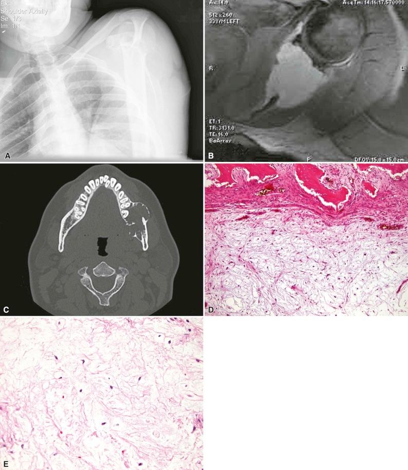 Figure 12-5, A, Circumscribed expansile lesion of the scapula with a vague trabeculated appearance. These features are nonspecific and do not allow for a radiologic diagnosis. B, The lesion has a high signal on T2-weighted magnetic resonance imaging indicative of a high fluid content, as can be seen in myxoid lesions. C, Destructive lesion of the mandible showing expansion of the bone laterally and cortical erosion medially indicative of more infiltrative growth that characterizes odontogenic myxoma. D, Low-power view of the scapular lesion in Figure 12-5A shows a circumscribed hypocellular spindle cell proliferation with pale myxoid stroma with few capillary vessels. The tumor is surrounded by a rim of reactive bone ( top ). E, Fibroblasts of fibromyxoma are widely spaced and have uniform small elongated and tapered nuclei with bipolar or stellate appearing cytoplasm.