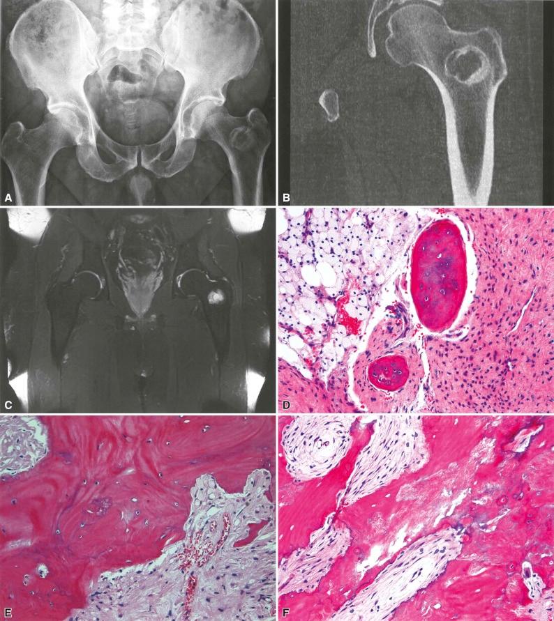 Figure 12-6, Circumscribed lesion with sclerotic border in the intertrochanteric region of the proximal femur characteristic of liposclerosing myxofibrous tumor (LSMFT) as evidenced by ( A ) conventional radiography and ( B ) computed tomography. C, High signal intensity on T2-weighted magnetic resonance images generally correlates with myxoid tissue in LSMFT. D, Fibroblastic stroma composed of uniform fibroblasts ( right ), bone trabeculae ( center ), and xanthoma cells ( left ) similar to what can be seen in fibrous dysplasia are present in LSMFT. E, Thick trabecular bone of LSMFT with evidence of extensive remodeling (Paget-like), including numerous cement lines and osteoclastic resorption sites on the surface. Fibromyxoid tissue is present as well ( lower right ). F, Ischemic ossification is characterized by irregularly mineralized fibrous tissue which is associated with nonviable lamellar bone. G, Adipocytes of varying sizes similar in appearance to atrophic fat admixed with nondescript small fibroblastic spindle cells and bone ( left ). H, Myxoid tissue in LSMFT is hypocellular with small elongated or stellate-shaped fibroblasts (Paget-like bone is seen at bottom).