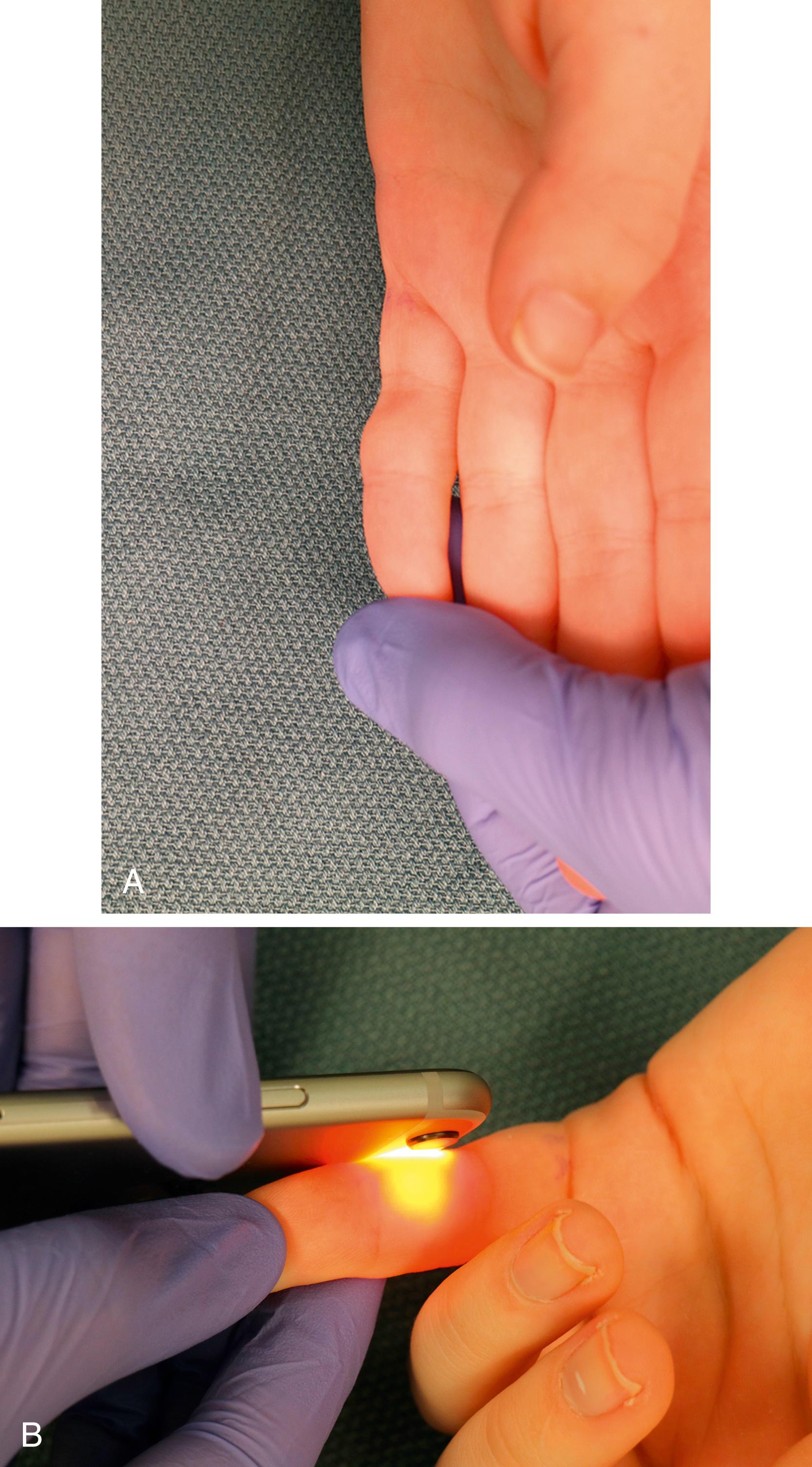 Fig. 60.1, (A) Volar mass of a small finger. (B) Diffuse glow of mass during transillumination with “flashlight” of a smart phone indicates cystic lesion, consistent with retinacular cyst.